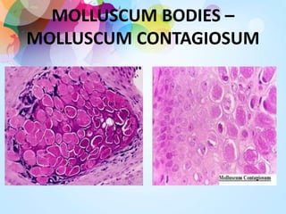 MOLLUSCUM BODIES –
MOLLUSCUM CONTAGIOSUM
 