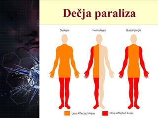 
De ja paralizačDe ja paralizač Dečja paraliza
 