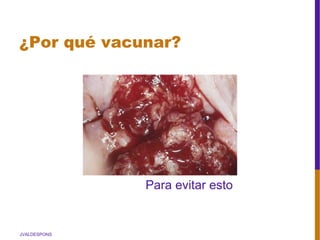 JVALDESPONS
¿Por qué vacunar?
Para evitar esto
 