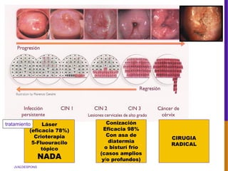 JVALDESPONS
Conización
Eficacia 98%
Con asa de
diatermia
o bisturí frío
(casos amplios
y/o profundos)
CIRUGIA
RADICAL
Láser
(eficacia 78%)
Crioterapia
5-Fluouracilo
tópico
NADA
tratamiento
 