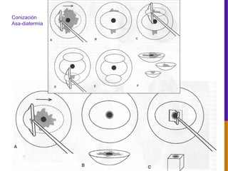 JVALDESPONS
Conización
Asa-diatermia
 
