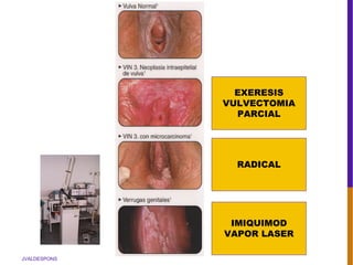 JVALDESPONS
EXERESIS
VULVECTOMIA
PARCIAL
RADICAL
IMIQUIMOD
VAPOR LASER
 