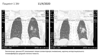 Пациент 1 34г 11/4/2020
Заключение: данные КТ показывают левую сегментарную пневмонию, картину интерстициального
пневмофиб...