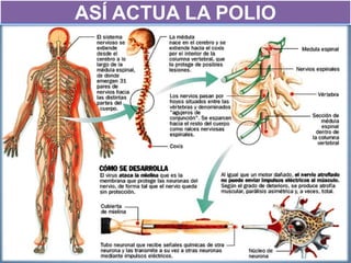 ASÍ ACTUA LA POLIO
 
