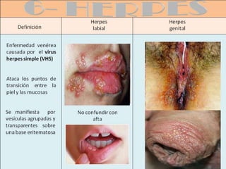 Enfermedad venérea
causada por el virus
herpes simple (VHS)
Herpes
labial
Herpes
genital
Ataca los puntos de
transición entre la
piel y las mucosas
Se manifiesta por
vesículas agrupadas y
transparentes sobre
una base eritematosa
Definición
No confundir con
afta
 