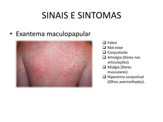 SINAIS E SINTOMAS
• Exantema maculopapular
 Febre
 Mal estar
 Conjuntivite
 Artralgia (Dores nas
articulações).
 Mialgia (Dores
musculares).
 Hiperemia conjuntival
(Olhos avermelhados).
 