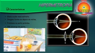  Características
 Globo ocular mais estreito.
 Imagem forma-se depois da retina.
 Problema no ponto próximo.
 Não enxerga de perto.
 