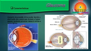 Aumento da pressão intra-ocular devido a
obstrução dos canais que drenam o humor
aquoso, podendo provocar danos à retina e
nervo óptico.
 Características
 