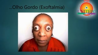 ...Olho Gordo (Exoftalmia)
 