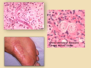 Cross-section of Toxocara
Larvae in liver tissue
 