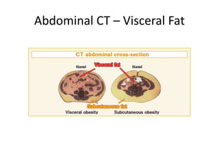 Abdominal CT – Visceral Fat
 