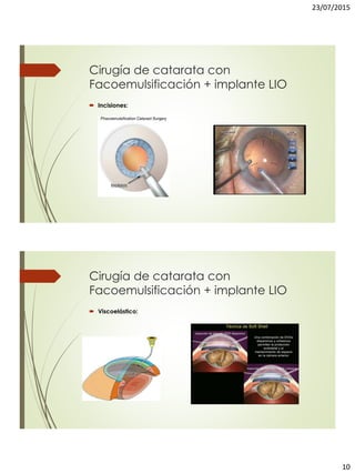 23/07/2015
10
Cirugía de catarata con
Facoemulsificación + implante LIO
 Incisiones:
Cirugía de catarata con
Facoemulsificación + implante LIO
 Viscoelástico:
 