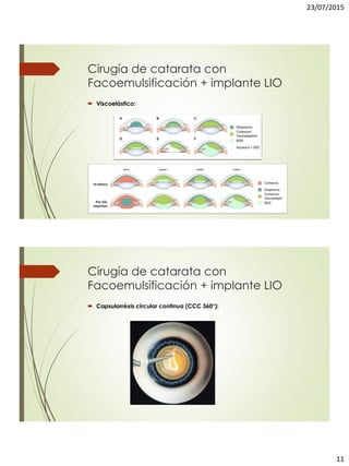 23/07/2015
11
Cirugía de catarata con
Facoemulsificación + implante LIO
 Viscoelástico:
Cirugía de catarata con
Facoemulsificación + implante LIO
 Capsulorréxis circular continua (CCC 360°):
 