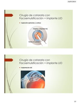23/07/2015
13
Cirugía de catarata con
Facoemulsificación + implante LIO
 Aspiración epinúcleo y corteza:
Cirugía de catarata con
Facoemulsificación + implante LIO
 Implantación LIO:
 