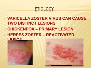 chickenpox | PPTX