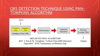 QRS DETECTION TECHNIQUE USING PAN-
TOMPKINS ALGORITHM
 