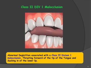 36
Abnormal Deglutition associated with a Class II Divison 1
malocclusion. Thrusting forward of the tip of the Tongue and
Sucking in of the lower lip.
Class II DIV 1 Malocclusion
 