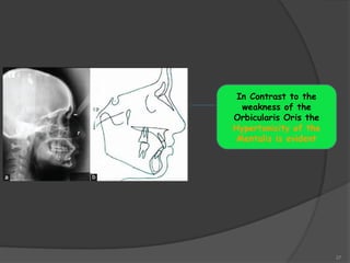 37
In Contrast to the
weakness of the
Orbicularis Oris the
Hypertonicity of the
Mentalis is evident
 