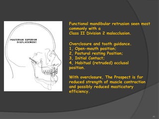 40
Functional mandibular retrusion seen most
commonly with a
Class II Division 2 malocclusion.
Overclosure and tooth guidance.
1, Open-mouth position;
2, Postural resting Position;
3, Initial Contact;
4, Habitual (retruded) occlusal
position.
With overclosure, The Prospect is for
reduced strength of muscle contraction
and possibly reduced masticatory
efficiency.
 