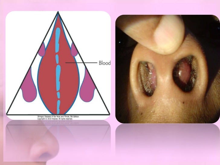 NASAL SEPTAL DISEASES