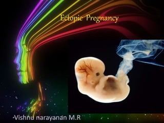 Vishnu narayanan M.R
Ectopic Pregnancy
 