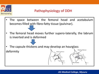 JSS Medical College, Mysuru
Pathophysiology of DDH
• The space between the femoral head and acetabulum
becomes filled with fibro-fatty tissue (pulvinar).
• The femoral head moves further supero-laterally, the labrum
is inverted and is deformed
• The capsule thickens and may develop an hourglass
deformity
 