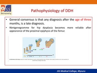 JSS Medical College, Mysuru
Pathophysiology of DDH
• General consensus is that any diagnosis after the age of three
months, is a late diagnosis.
• Röntgenogramme for hip dysplasia becomes more reliable after
appearance of the proximal epiphysis of the femur.
 