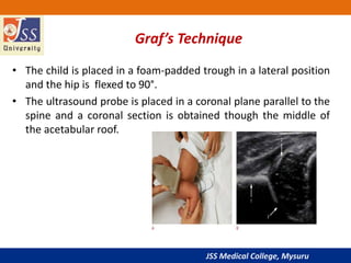 JSS Medical College, Mysuru
Graf’s Technique
• The child is placed in a foam-padded trough in a lateral position
and the hip is flexed to 90°.
• The ultrasound probe is placed in a coronal plane parallel to the
spine and a coronal section is obtained though the middle of
the acetabular roof.
 