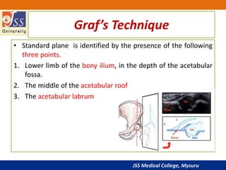 JSS Medical College, Mysuru
Graf’s Technique
• Standard plane is identified by the presence of the following
three points.
1. Lower limb of the bony ilium, in the depth of the acetabular
fossa.
2. The middle of the acetabular roof
3. The acetabular labrum
 