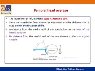 JSS Medical College, Mysuru
Femoral head overage
• The lower limit of FHC in infants aged >1month is 50%.
• Since the acetabular fossa cannot be visualized in older children; FHC is
used only in the first year of life.
• A=distance from the medial wall of the acetabulum to the level of the
lateral bony rim
• B= distance from the medial wall of the acetabulum to the lateral joint
capsule
 