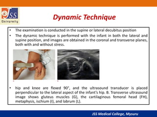JSS Medical College, Mysuru
Dynamic Technique
• The examination is conducted in the supine or lateral decubitus position
• The dynamic technique is performed with the infant in both the lateral and
supine position, and images are obtained in the coronal and transverse planes,
both with and without stress.
• hip and knee are flexed 90°, and the ultrasound transducer is placed
perpendicular to the lateral aspect of the infant’s hip. B. Transverse ultrasound
image shows gluteus muscles (G), the cartilaginous femoral head (FH),
metaphysis, ischium (I), and labrum (L).
 
