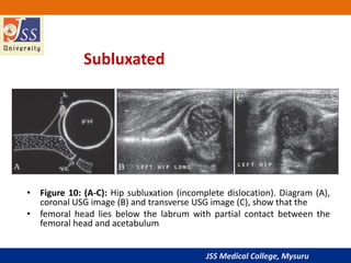 JSS Medical College, Mysuru
• Figure 10: (A-C): Hip subluxation (incomplete dislocation). Diagram (A),
coronal USG image (B) and transverse USG image (C), show that the
• femoral head lies below the labrum with partial contact between the
femoral head and acetabulum
Subluxated
 
