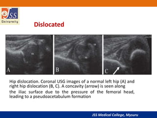 JSS Medical College, Mysuru
Dislocated
Hip dislocation. Coronal USG images of a normal left hip (A) and
right hip dislocation (B, C). A concavity (arrow) is seen along
the iliac surface due to the pressure of the femoral head,
leading to a pseudoacetabulum formation
 