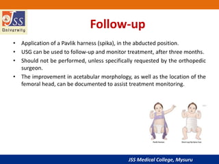 JSS Medical College, Mysuru
Follow-up
• Application of a Pavlik harness (spika), in the abducted position.
• USG can be used to follow-up and monitor treatment, after three months.
• Should not be performed, unless specifically requested by the orthopedic
surgeon.
• The improvement in acetabular morphology, as well as the location of the
femoral head, can be documented to assist treatment monitoring.
 