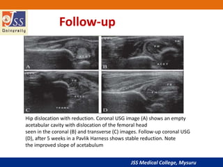 JSS Medical College, Mysuru
Follow-up
Hip dislocation with reduction. Coronal USG image (A) shows an empty
acetabular cavity with dislocation of the femoral head
seen in the coronal (B) and transverse (C) images. Follow-up coronal USG
(D), after 5 weeks in a Pavlik Harness shows stable reduction. Note
the improved slope of acetabulum
 
