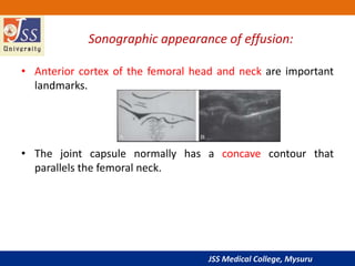 JSS Medical College, Mysuru
Sonographic appearance of effusion:
• Anterior cortex of the femoral head and neck are important
landmarks.
• The joint capsule normally has a concave contour that
parallels the femoral neck.
 