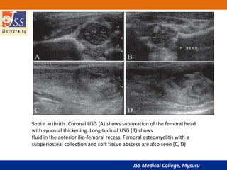 JSS Medical College, Mysuru
Septic arthritis. Coronal USG (A) shows subluxation of the femoral head
with synovial thickening. Longitudinal USG (B) shows
fluid in the anterior ilio-femoral recess. Femoral osteomyelitis with a
subperiosteal collection and soft tissue abscess are also seen (C, D)
 