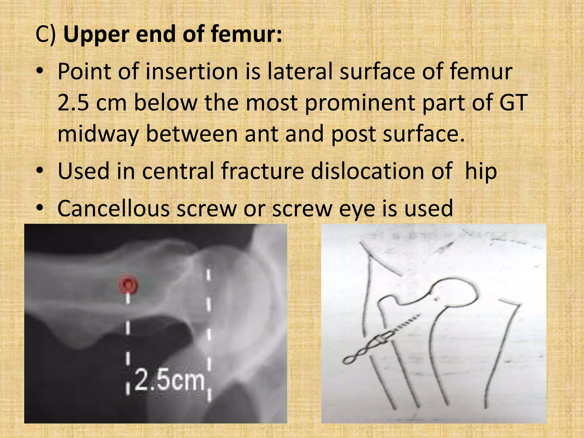 PPT ON TRACTIONS IN ORTHOPAEDICS