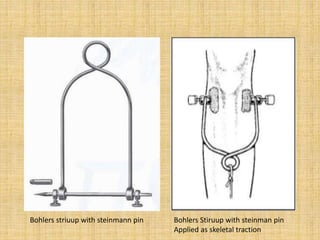 Skin Traction Equipment