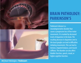 Parkinson’s disease is a
neurodegenerative disorder that
causes a progressive loss of fine motor
movements. It is marked by decreased
levels of dopamine in the brain.The
resulting decrease in dopamine sent to
the basal ganglia can lead to difficulties
initiating movements.This can lead to
tremors, impaired balance, and muscle
stiffness.The disorder can also affect
bladder function, speech, mood, or
higher cognitive function.
BRAIN PATHOLOGY:
PARKINSON’S
34 | Brain Pathologies> Parkinson’s
 