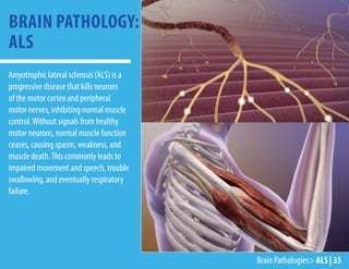 Brain Pathologies> ALS | 35
Amyotrophic lateral sclerosis (ALS) is a
progressive disease that kills neurons
of the motor cortex and peripheral
motor nerves, inhibiting normal muscle
control.Without signals from healthy
motor neurons, normal muscle function
ceases, causing spasm, weakness, and
muscle death.This commonly leads to
impaired movement and speech, trouble
swallowing, and eventually respiratory
failure.
BRAIN PATHOLOGY:
ALS
 