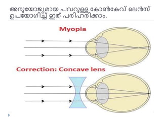 അേുനയാജ്യമായ പവറുള്ള നകാൺനകവ് ലെൻസ്
ഉപനയാ ിച്ച് ഇത് പരിഹരിക്കാം.
 