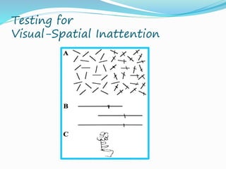 Visual Inattention Test Visioary ophthalmology tbi presentation 9.7.14