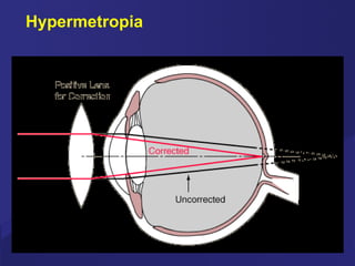 Hypermetropia 