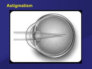Astigmatism 