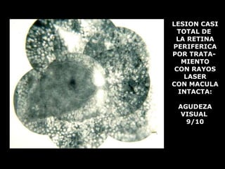 drpabloarias@hotmail.com
Fisiología de la Visión 38
AGUDEZA VISUAL LESION CASI
TOTAL DE
LA RETINA
PERIFERICA
POR TRATA-
MIENTO
CON RAYOS
LASER
CON MACULA
INTACTA:
AGUDEZA
VISUAL
9/10
 