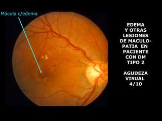 drpabloarias@hotmail.com
Fisiología de la Visión 39
AGUDEZA VISUAL
EDEMA
Y OTRAS
LESIONES
DE MACULO-
PATIA EN
PACIENTE
CON DM
TIPO 2
AGUDEZA
VISUAL
4/10
Mácula c/edema
 