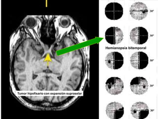drpabloarias@hotmail.com
Fisiología de la Visión 46
Traumatismo con fractura de orbita izquierda
Tumor hipofisario con expansión supraselar
Hemianopsia bitemporal
 