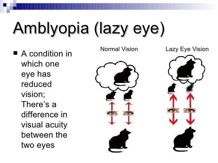 vision therapy vision therapy