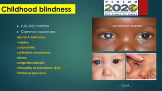  0.8/1000 children
 Common causes are
vitamin A deficiency,
measles,
conjunctivitis,
ophthalmia neonatorum,
injuries,
congenital cataract,
retinopathy of prematurity (ROP)
childhood glaucoma.
Childhood blindness
Cont….
 
